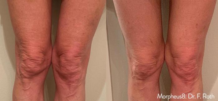 Before & After Y Lift Instant Facelift Case 155 View 1 View in Santa Rosa, California