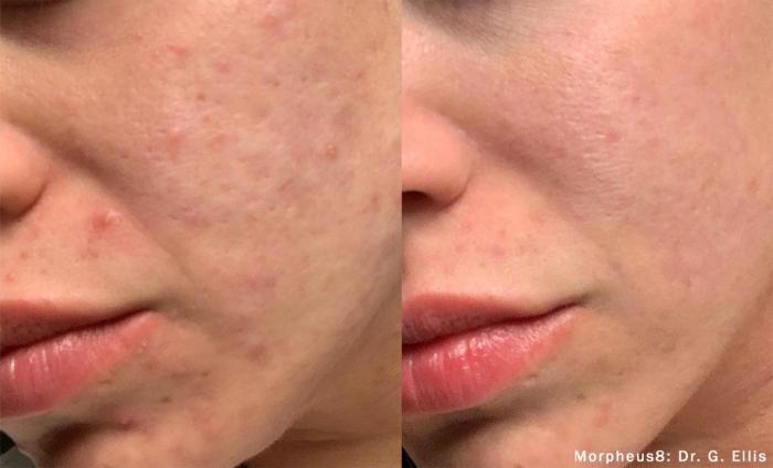 Before & After Y Lift Instant Facelift Case 156 View 1 View in Santa Rosa, California