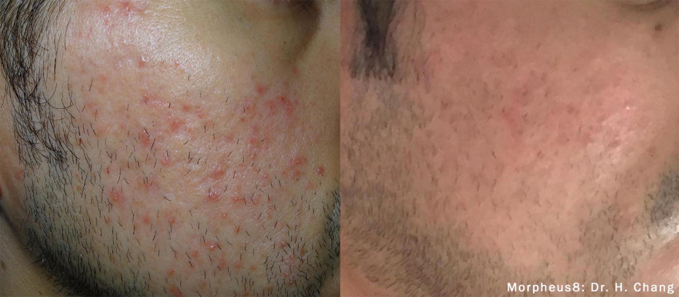 Before & After Y Lift Instant Facelift Case 157 View 1 View in Santa Rosa, California