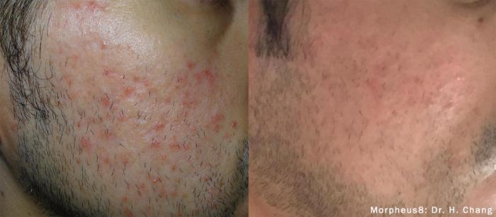 Before & After Y Lift Instant Facelift Case 157 View 1 View in Santa Rosa, California