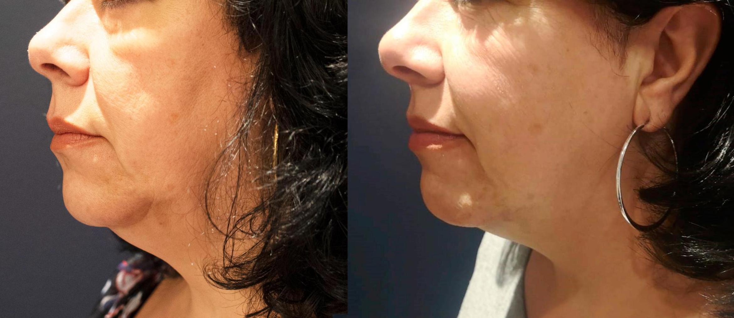 Before & After Y Lift Instant Facelift Case 158 View 1 View in Santa Rosa, California
