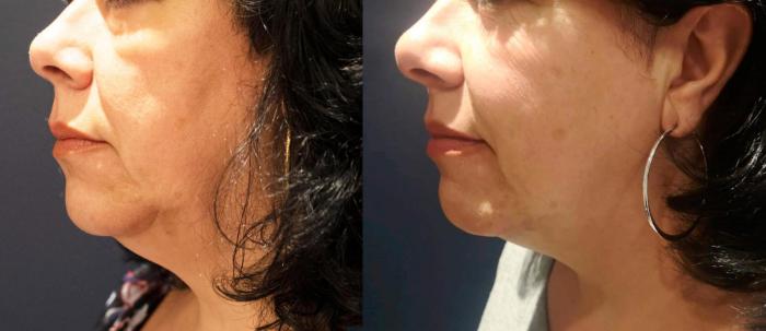 Before & After Y Lift Instant Facelift Case 158 View 1 View in Santa Rosa, California
