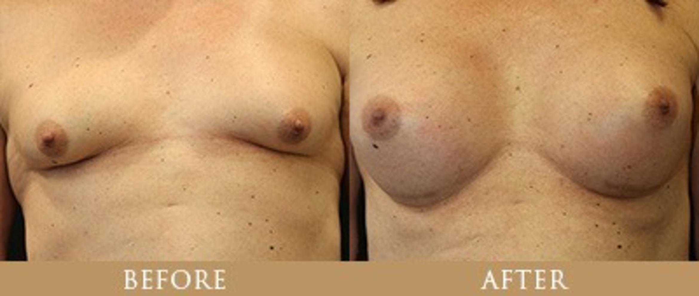Before & After Y Lift Instant Facelift Case 159 View 1 View in Santa Rosa, California