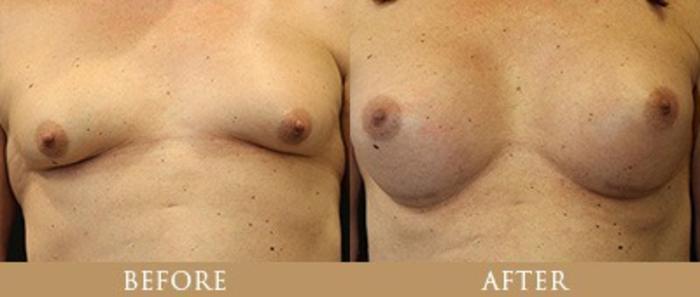 Before & After Y Lift Instant Facelift Case 159 View 1 View in Santa Rosa, California