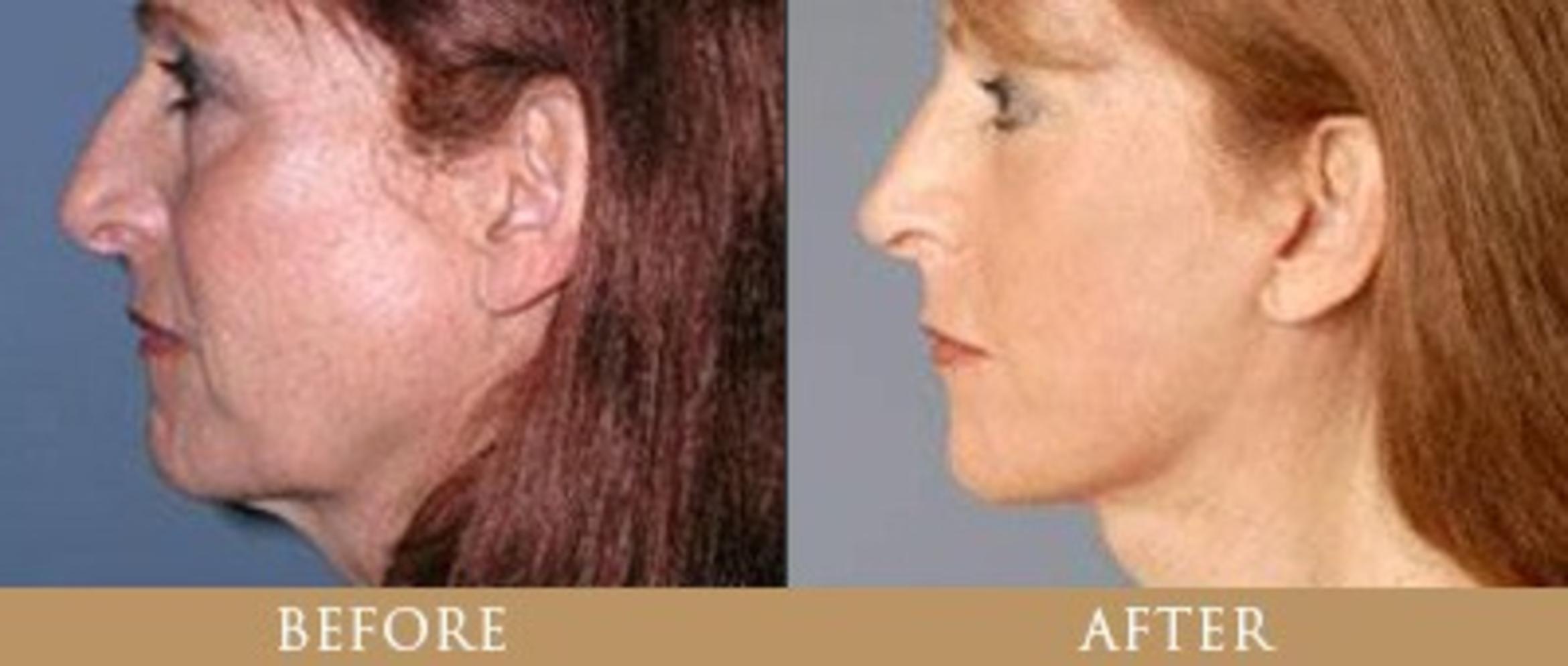Before & After Y Lift Instant Facelift Case 160 View 1 View in Santa Rosa, California