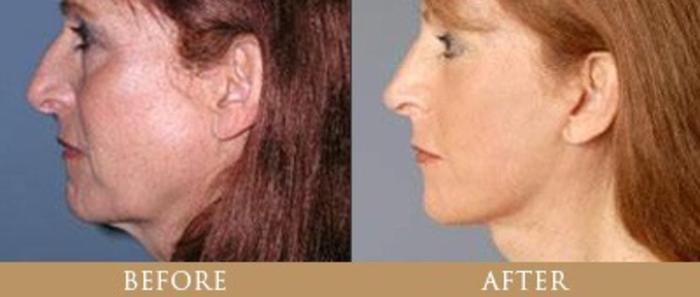 Before & After Y Lift Instant Facelift Case 160 View 1 View in Santa Rosa, California