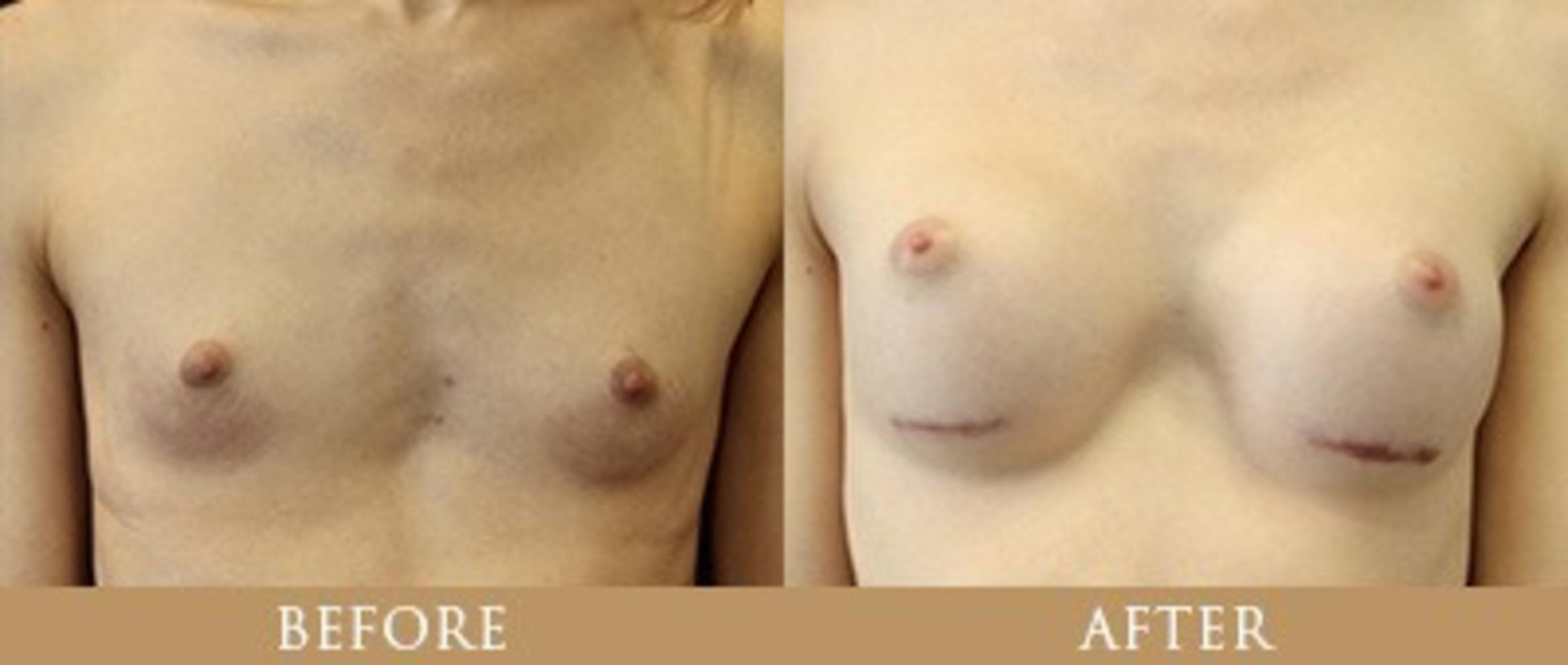 Before & After Y Lift Instant Facelift Case 161 View 1 View in Santa Rosa, California