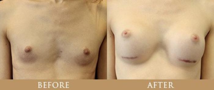 Before & After Y Lift Instant Facelift Case 161 View 1 View in Santa Rosa, California