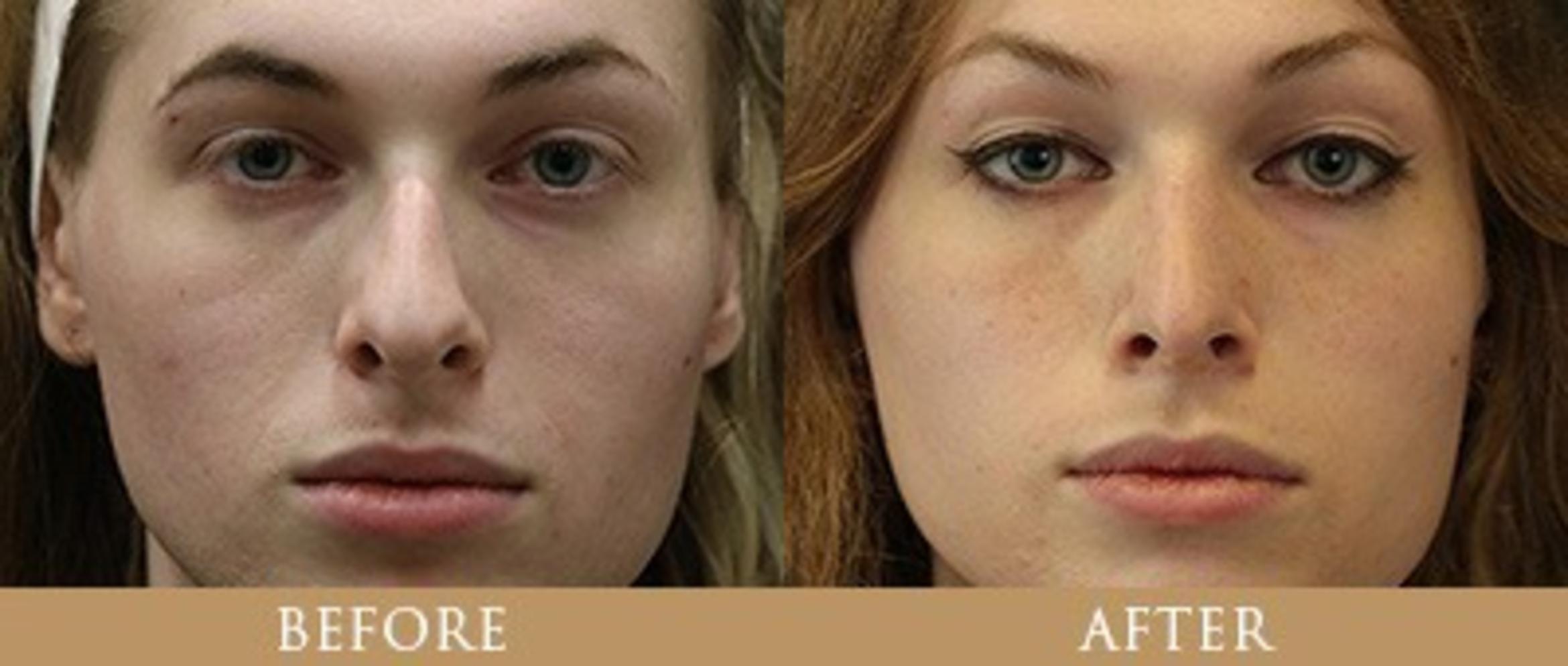 Before & After Y Lift Instant Facelift Case 162 View 1 View in Santa Rosa, California