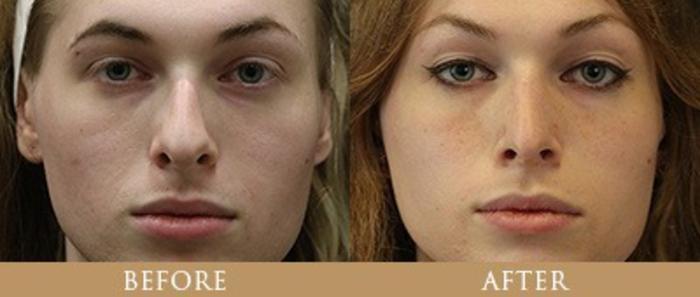 Before & After Y Lift Instant Facelift Case 162 View 1 View in Santa Rosa, California