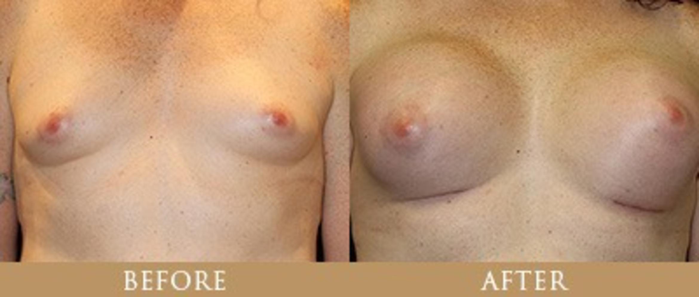 Before & After Y Lift Instant Facelift Case 163 View 1 View in Santa Rosa, California