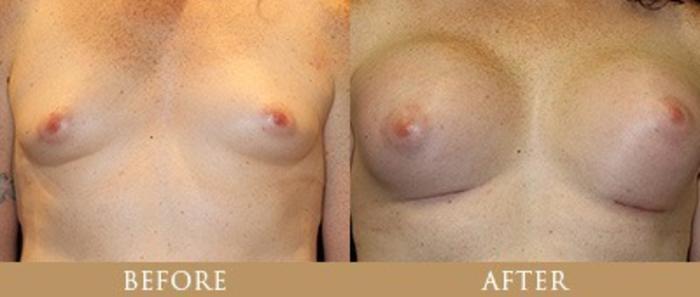 Before & After Y Lift Instant Facelift Case 163 View 1 View in Santa Rosa, California