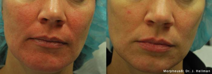 Before & After Y Lift Instant Facelift Case 197 View 1 View in Santa Rosa, California
