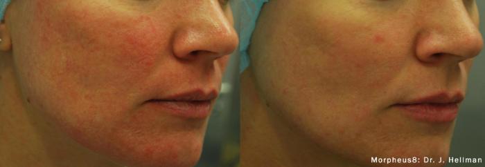 Before & After Y Lift Instant Facelift Case 197 View 2 View in Santa Rosa, California
