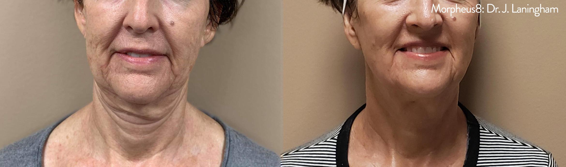 Before & After Y Lift Instant Facelift Case 250 View 1 View in Santa Rosa, California