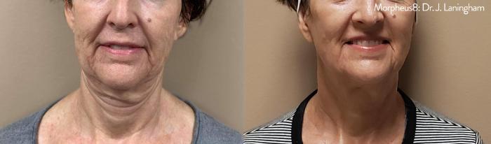 Before & After Y Lift Instant Facelift Case 250 View 1 View in Santa Rosa, California