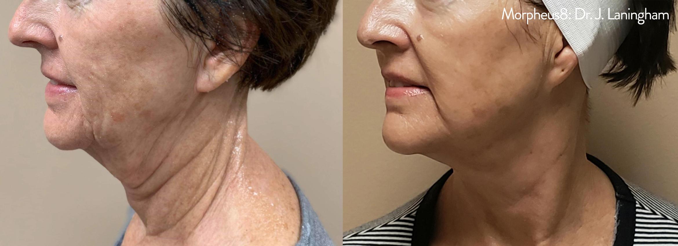 Before & After Y Lift Instant Facelift Case 250 View 2 View in Santa Rosa, California
