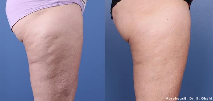 Before & After Y Lift Instant Facelift Case 251 View 1 View in Santa Rosa, California