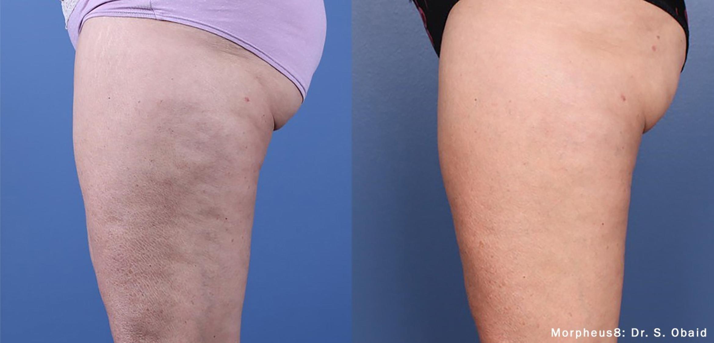 Before & After Y Lift Instant Facelift Case 251 View 2 View in Santa Rosa, California