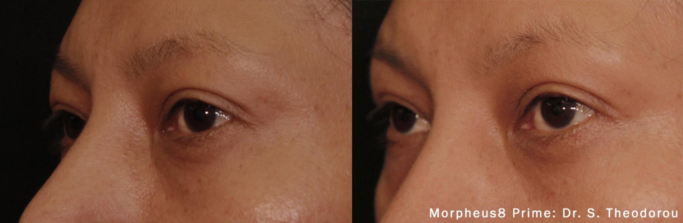 Before & After Y Lift Instant Facelift Case 252 View 1 View in Santa Rosa, California