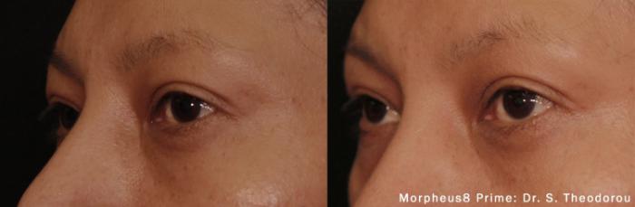 Before & After Y Lift Instant Facelift Case 252 View 1 View in Santa Rosa, California
