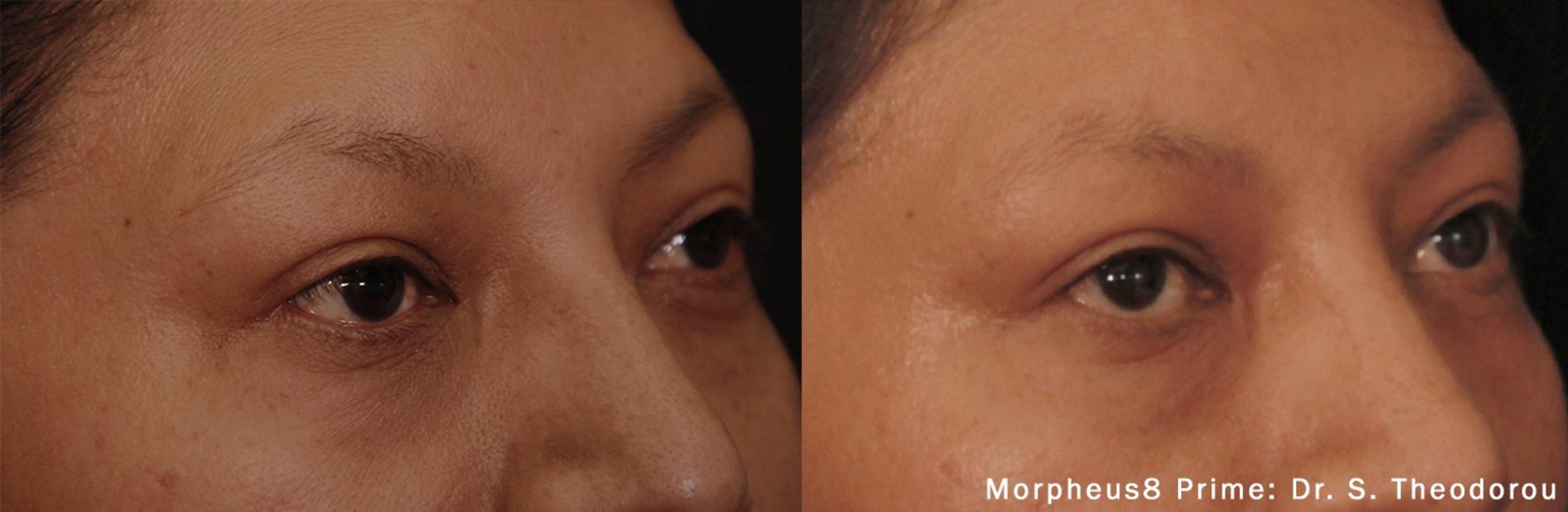 Before & After Y Lift Instant Facelift Case 252 View 2 View in Santa Rosa, California