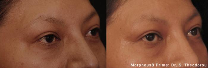 Before & After Y Lift Instant Facelift Case 252 View 2 View in Santa Rosa, California