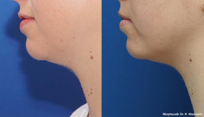 Before & After Y Lift Instant Facelift Case 253 View 1 View in Santa Rosa, California