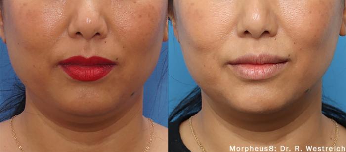 Before & After Y Lift Instant Facelift Case 254 View 1 View in Santa Rosa, California