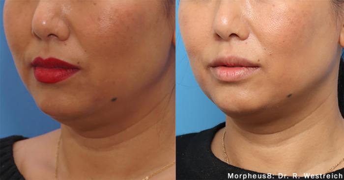 Before & After Y Lift Instant Facelift Case 254 View 2 View in Santa Rosa, California