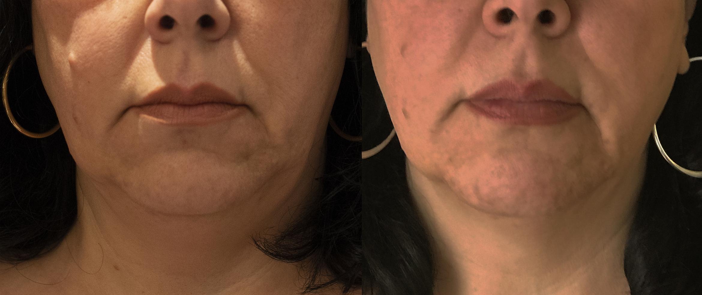Before & After Y Lift Instant Facelift Case 255 View 1 View in Santa Rosa, California