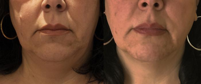 Before & After Y Lift Instant Facelift Case 255 View 1 View in Santa Rosa, California