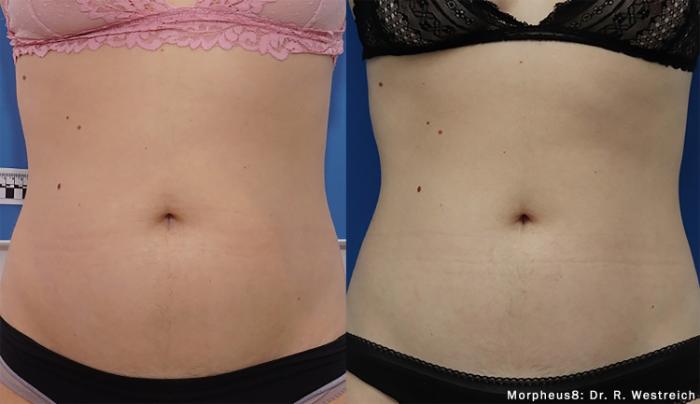 Before & After Y Lift Instant Facelift Case 256 View 1 View in Santa Rosa, California