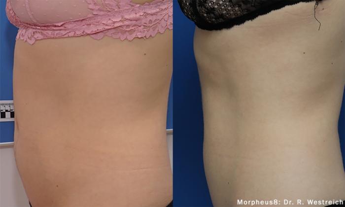 Before & After Y Lift Instant Facelift Case 256 View 2 View in Santa Rosa, California
