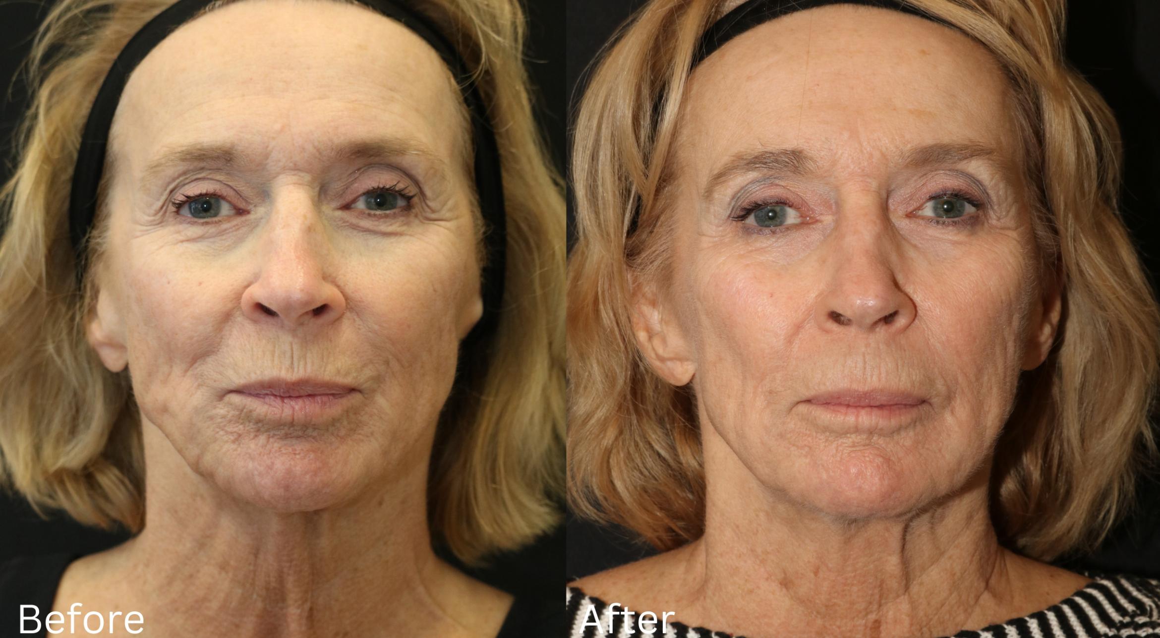 Before & After Y Lift Instant Facelift Case 259 View 1 View in Santa Rosa, California