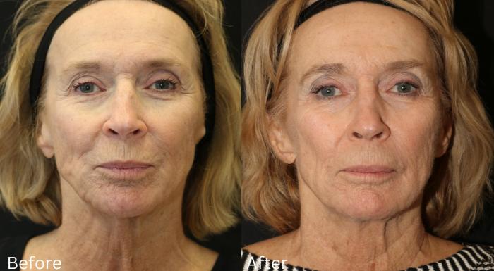 Before & After Y Lift Instant Facelift Case 259 View 1 View in Santa Rosa, California