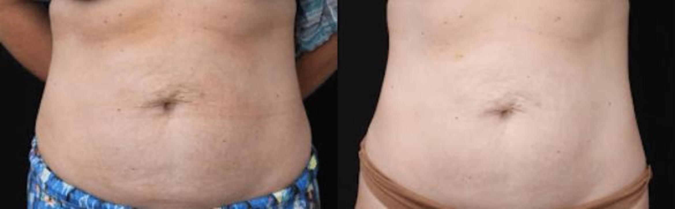 Before & After Y Lift Instant Facelift Case 263 View 1 View in Santa Rosa, California