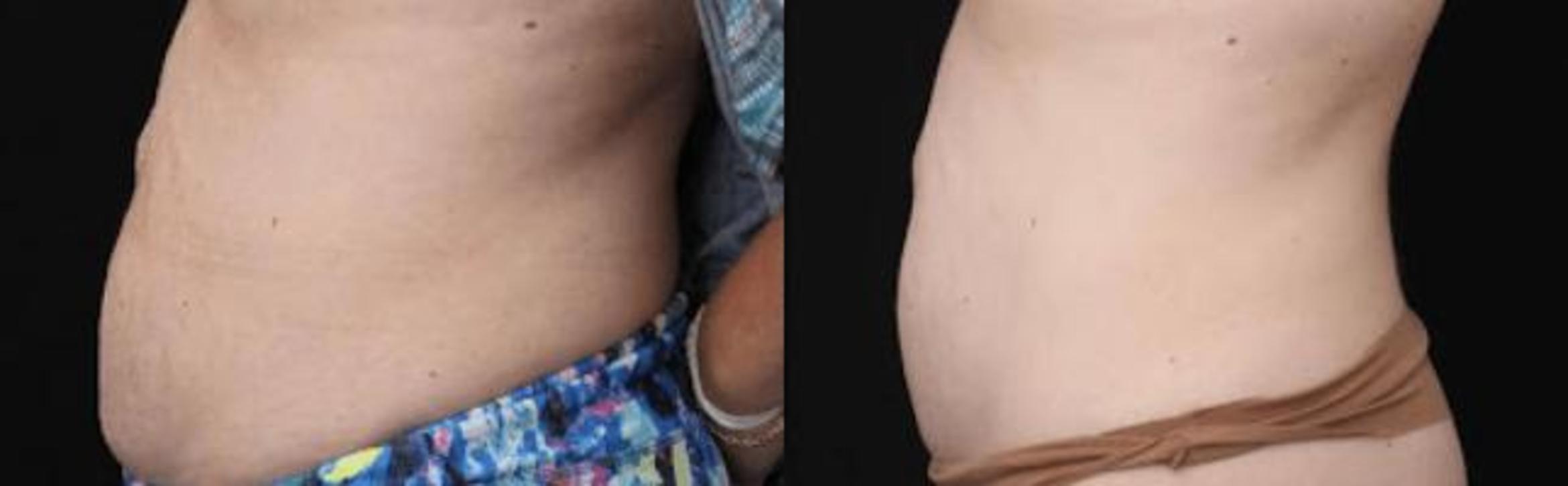 Before & After Y Lift Instant Facelift Case 263 View 2 View in Santa Rosa, California