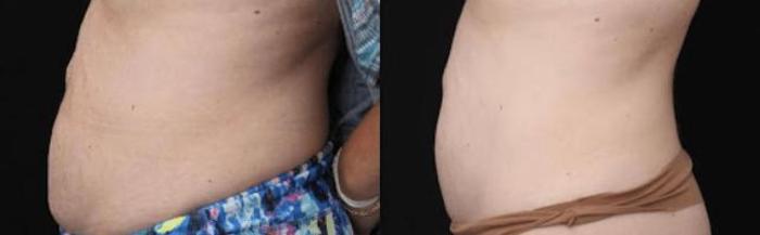 Before & After Y Lift Instant Facelift Case 263 View 2 View in Santa Rosa, California
