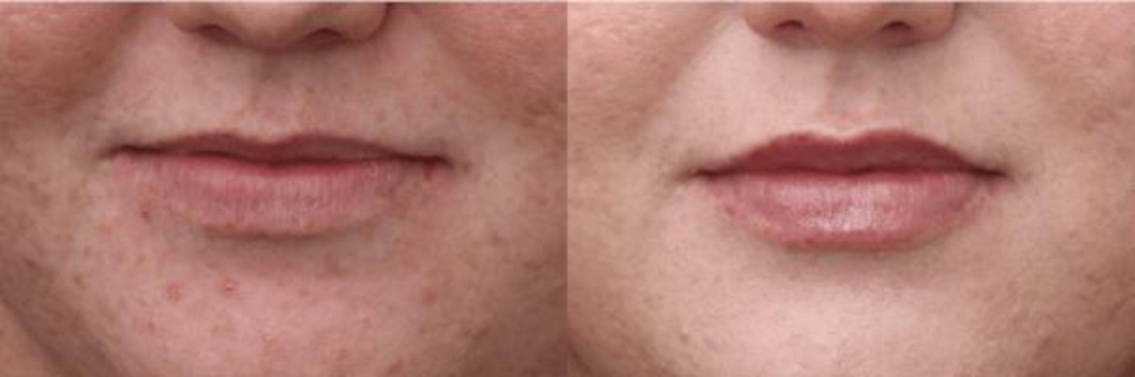 Before & After Y Lift Instant Facelift Case 288 View 1 View in Santa Rosa, California