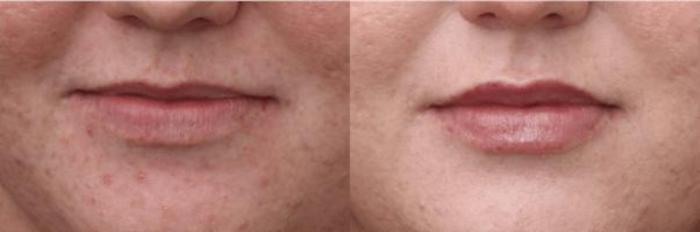 Before & After Y Lift Instant Facelift Case 288 View 1 View in Santa Rosa, California