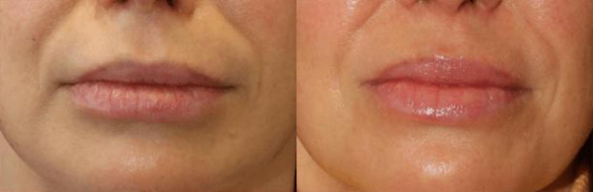 Before & After Y Lift Instant Facelift Case 289 View 1 View in Santa Rosa, California