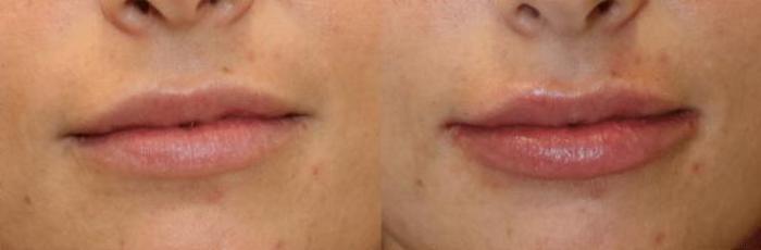 Before & After Y Lift Instant Facelift Case 290 View 1 View in Santa Rosa, California