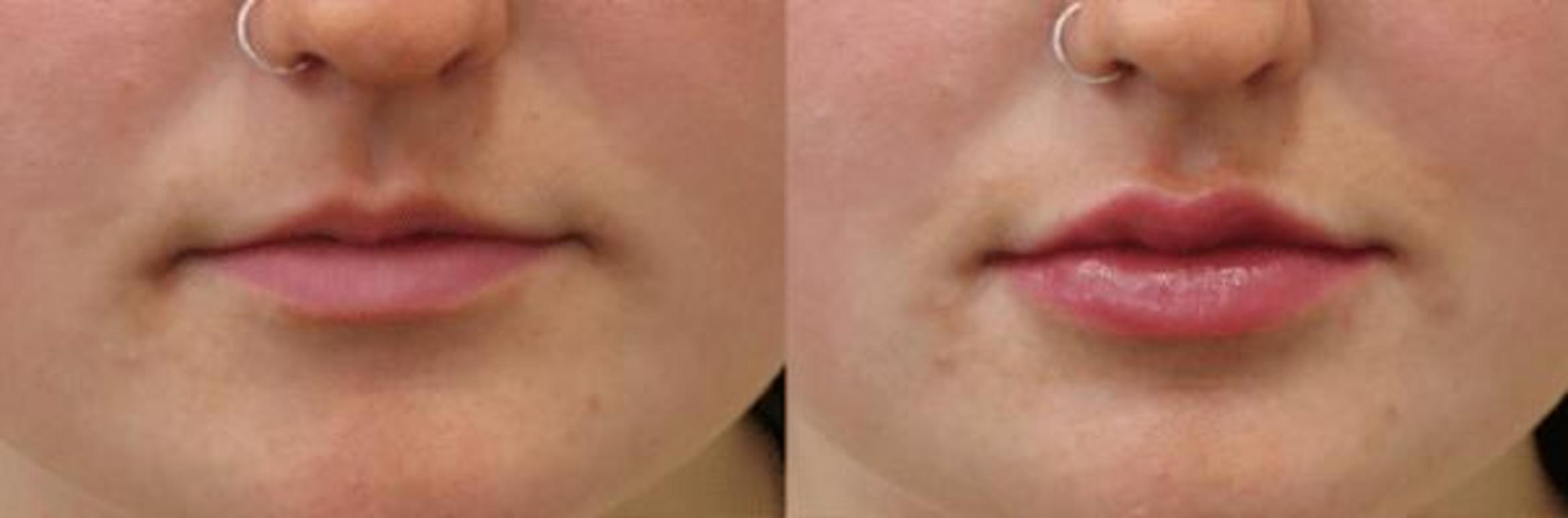 Before & After Y Lift Instant Facelift Case 291 View 1 View in Santa Rosa, California