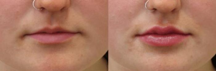 Before & After Y Lift Instant Facelift Case 291 View 1 View in Santa Rosa, California