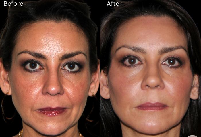 Before & After Y Lift Instant Facelift Case 338 View 1 View in Santa Rosa, California