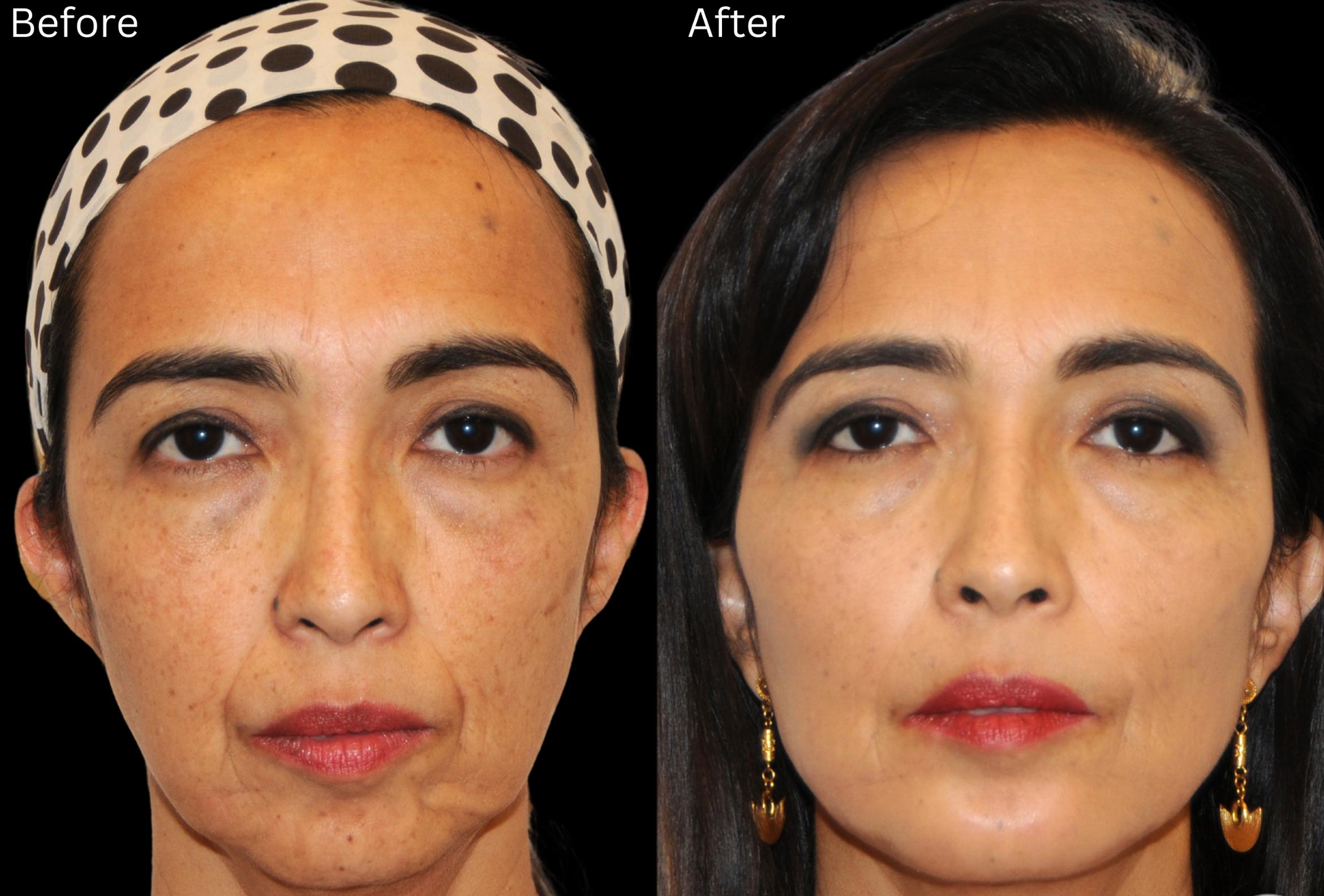 Before & After Y Lift Instant Facelift Case 339 View 1 View in Santa Rosa, California