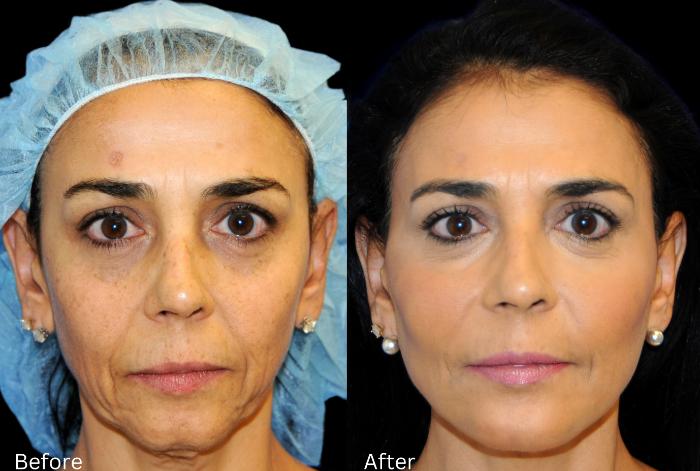 Before & After Y Lift Instant Facelift Case 340 View 1 View in Santa Rosa, California