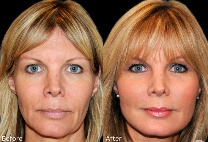Before & After Y Lift Instant Facelift Case 341 View 1 View in Santa Rosa, California