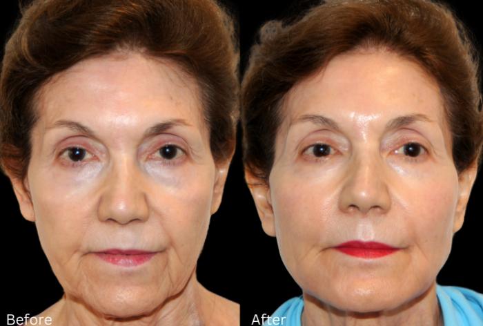 Before & After Y Lift Instant Facelift Case 342 View 1 View in Santa Rosa, California
